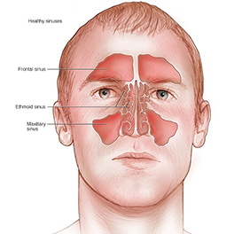 Rhinitis