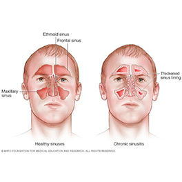 Sinusitis